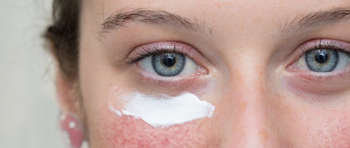 Die richtige Sonnencreme bei Rosacea Eucerin