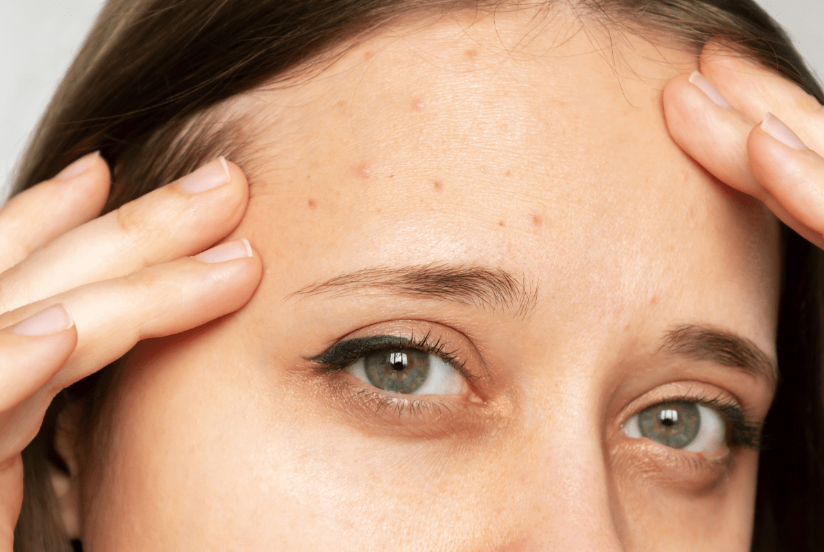 สิวผดที่หน้าผาก