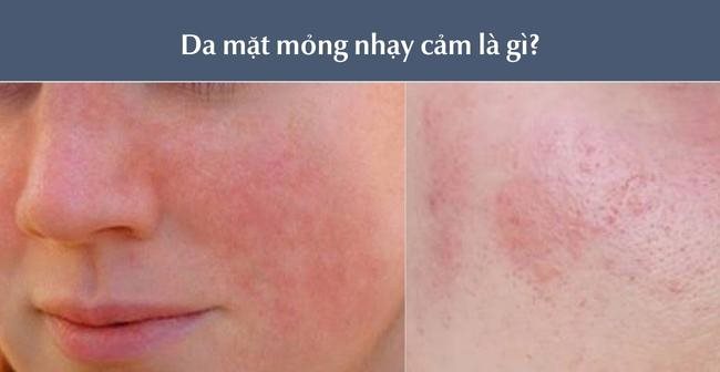 Da mặt mỏng nhạy cảm là gì?