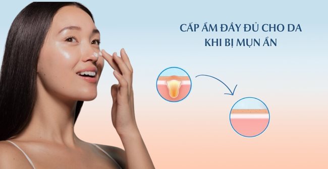 Cấp ẩm đầy đủ cho da bị mụn ẩn