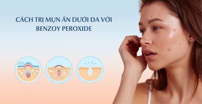 Cách trị mụn ẩn với Benzoyl Peroxide