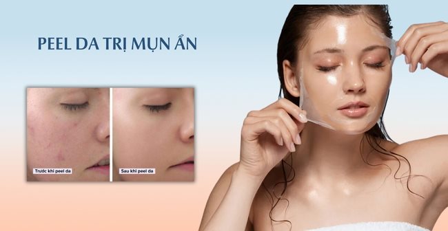 Peel da trị mụn ẩn