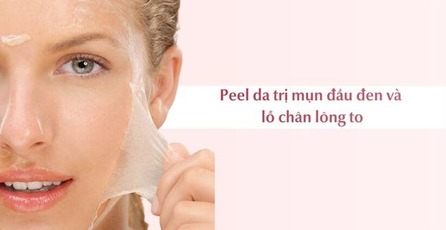 Cách trị mụn đầu đen và lỗ chân lông to bằng phương pháp peel da