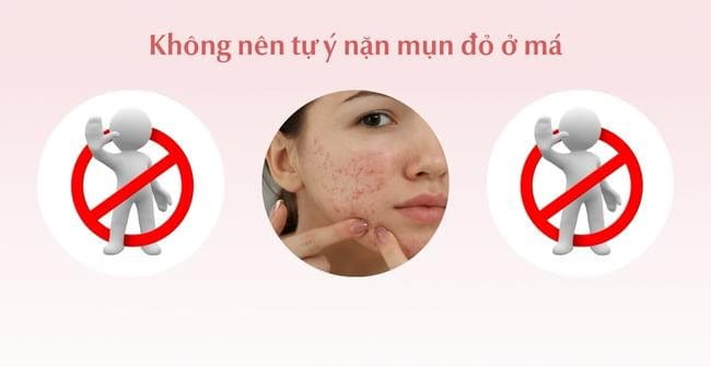 Mụn đỏ 2 bên má có tự hết không? Có nên nặn không?