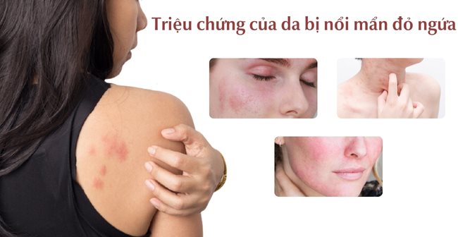 Triệu chứng của da bị nổi mẩn đỏ ngứa là gì?