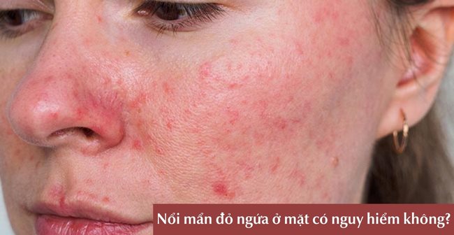 Nổi mẩn đỏ ngứa ở mặt có nguy hiểm không?