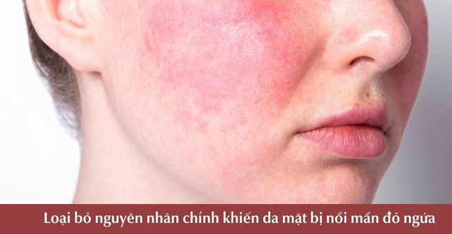 Tìm hiểu và loại bỏ nguyên nhân chính khiến da mặt bị nổi mẩn đỏ ngứa