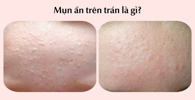 Mụn ẩn trên trán là gì?