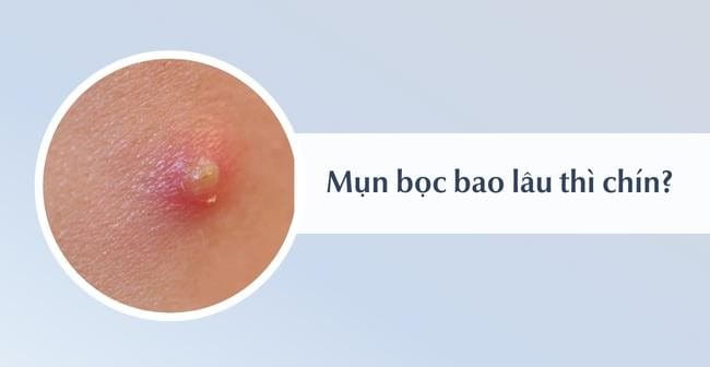 Mụn bọc bao lâu thì chín?