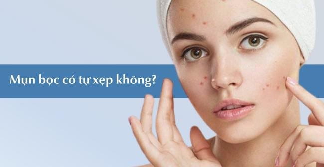 Mụn bọc có tự xẹp được hay không