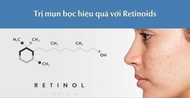 Trị mụn bọc bằng Retinoids