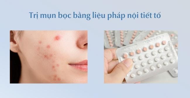 Trị mụn bọc bằng liệu pháp nội tiết tố