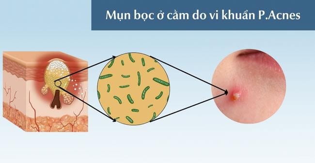 Nguyên nhân gây mụn bọc ở cằm