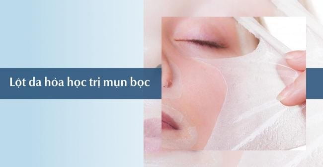 Lột da hóa học trị mụn bọc ở cằm