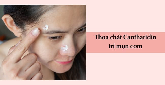 Thoa thuốc Axit salicylic điều trị mụn cơm