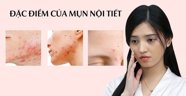 Đặc điểm của mụn nội tiết tố