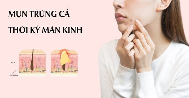 Mụn trứng cá do nội tiết tố giai đoạn mãn kinh