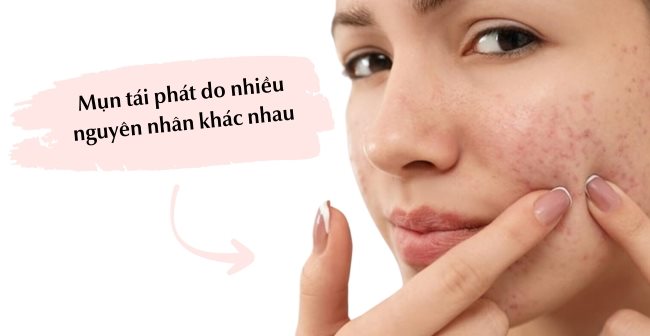 Vì Sao Mụn Hay Tái Phát? Cách Ngăn Mụn Tái Phát Hiệu Quả | Eucerin