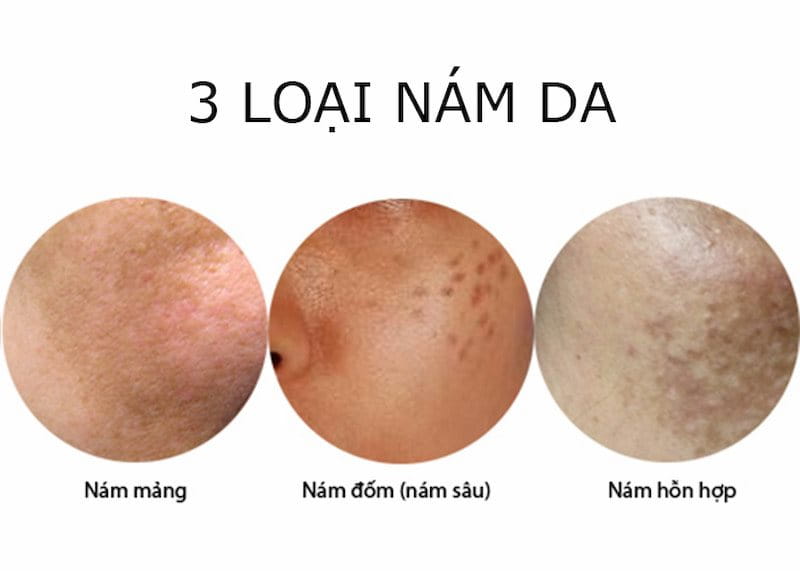 Phân biệt các loại nám phổ biến