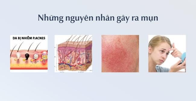 Nguyên Nhân Gây Mụn