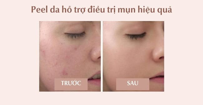 Chemical peels da có tác dụng hỗ trợ trị mụn hiệu quả