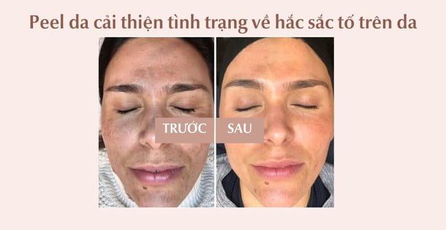 Chemical peels da có tác dụng giải quyết các tình trạng về hắc sắc tố trên da