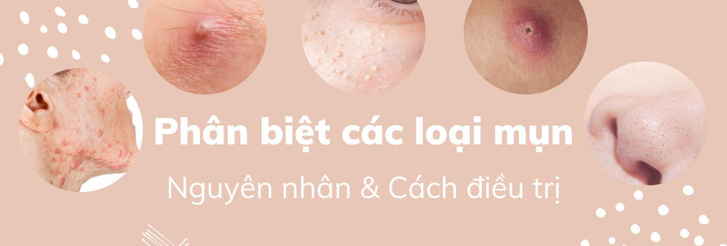 Mụn là gì?