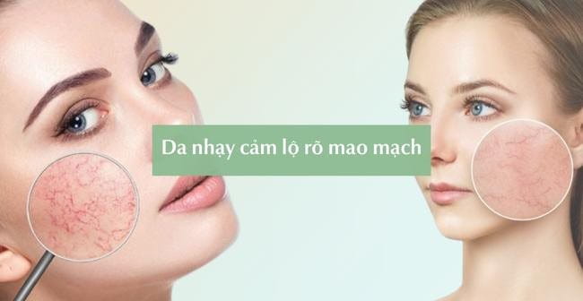 Da nhạy cảm làn có đặc điểm lộ rõ mao mạch