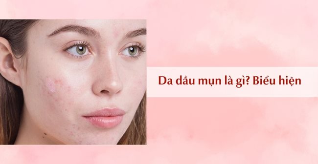 Da dầu mụn là gì?